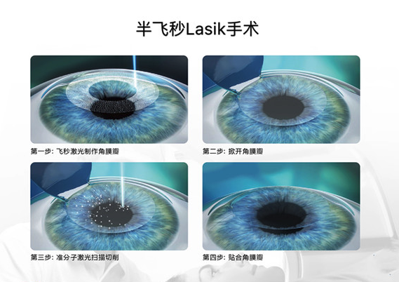 LASIK